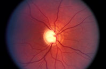 Close up of eye that needs prescription glasses in West Auckland